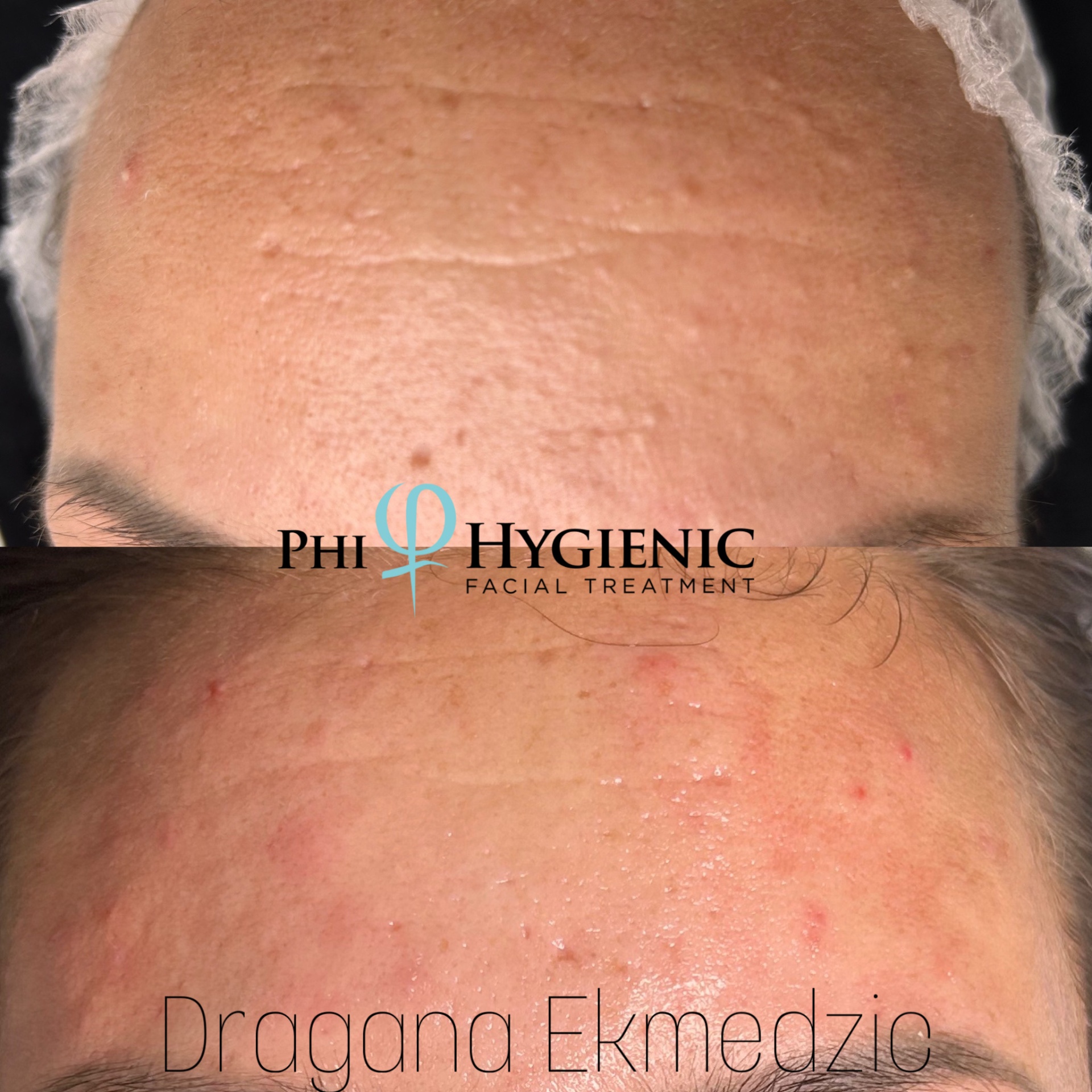 PhiHygienic — tretman lica