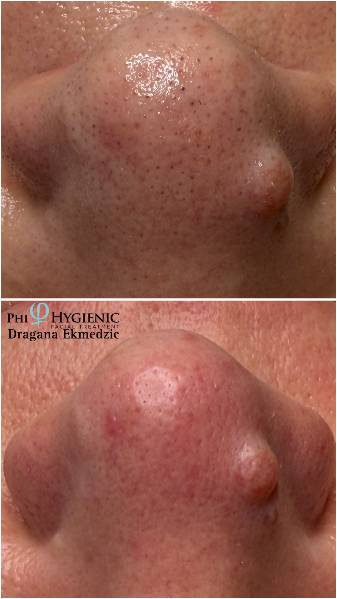 PhiHygienic — nos detalj